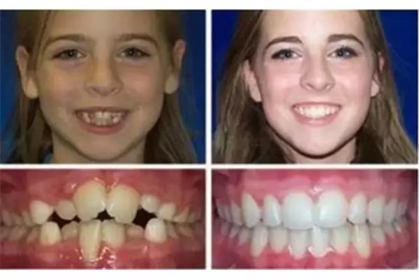 牙齒矯正拍片要多久,牙齒矯正拍片后要多久才能拿到方案?