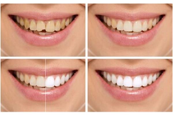 一口潔白的牙齒可以美白多久?冷光美白牙齒有什么效果?