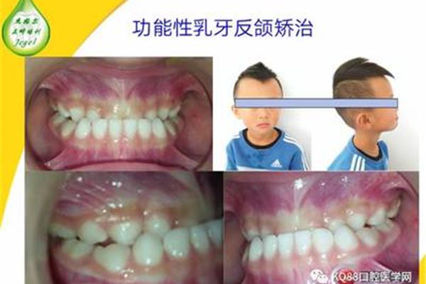 矯正孩子的牙齒需要多長時間?兒童乳牙如何矯正?