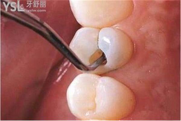 補樹脂牙能保持多久