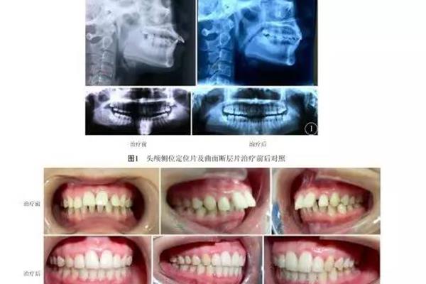 正畸前和正畸過程中的牙周治療