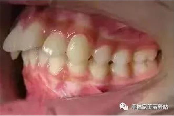 拔牙鑲牙最快是多久