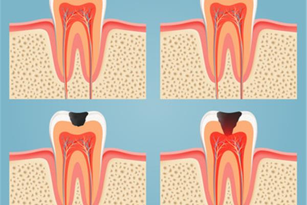 齲齒補牙能保持多久