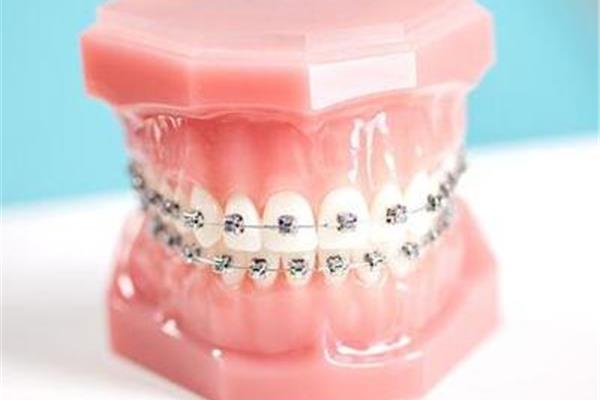 牙齒矯治器需要帶多久