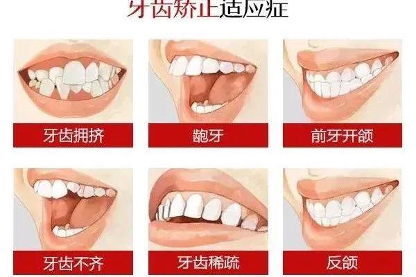 正畸需要多久適應,牙套矯正牙齒需要多久?
