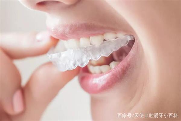 可摘式透明牙套應該戴多久,隱形義齒一般能用多久?