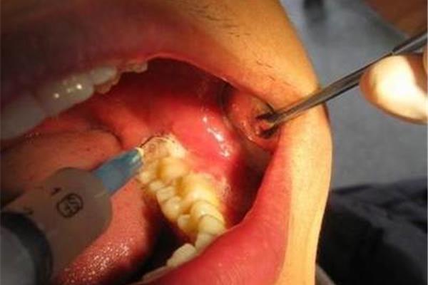 大牙拔了能種多久,多久能止血?