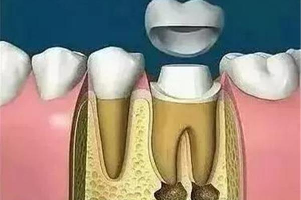 人的牙齒壽命有多久