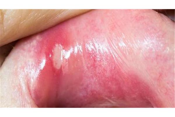 舌頭黏膜脫落吃什么藥?舌黏膜沒有它還能再長出來嗎?