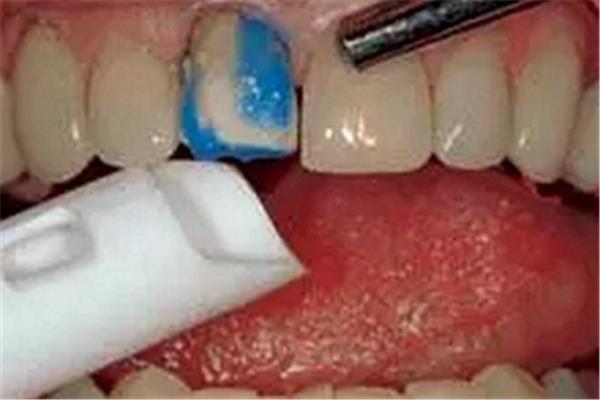 粘結的牙齒能堅持多久,樹脂能粘在牙齒上多久?