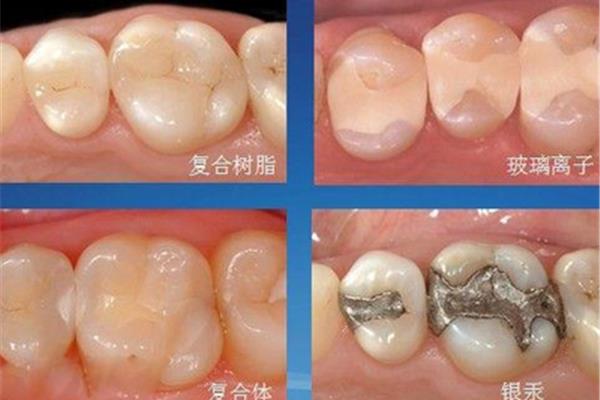 補牙的材料可以多久