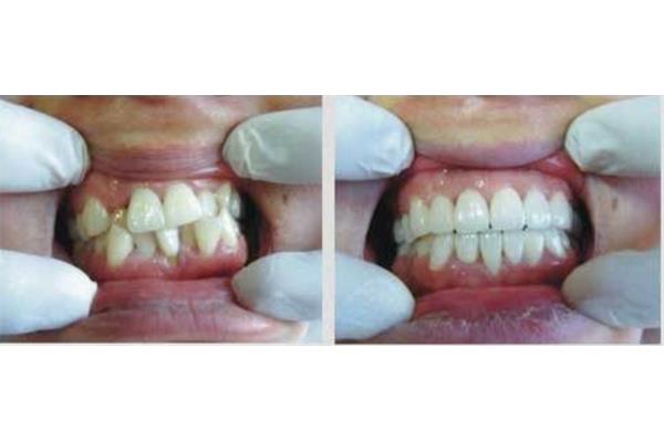 矯正輕微齙牙需要多久,矯正齙牙需要多久?