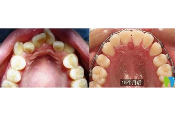 牙周炎的牙齒可以正畸嗎?中度牙周炎可以正畸嗎?