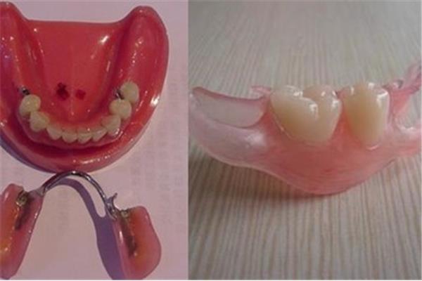 義牙齒能用多久