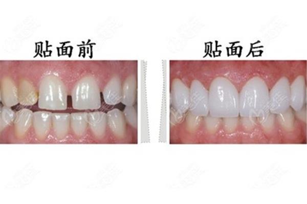 一般洗牙能持續多久?什么是齒面?