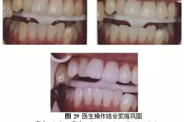 牙齒漂白能持續多久,牙齒漂白能持續多久?