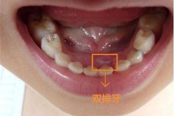 正畸牙齒的微調需要多久,正畸牙齒的微調階段需要多久?