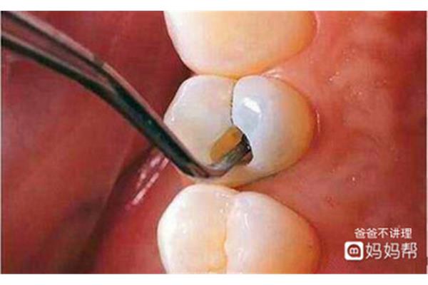 拔牙后多久可以補其他牙?一般拔牙幾個月后就可以補牙了