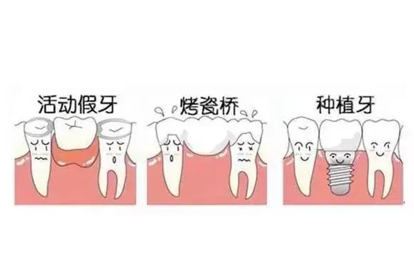 拔牙后多久牙疼?種植牙打樁后牙疼需要幾天?