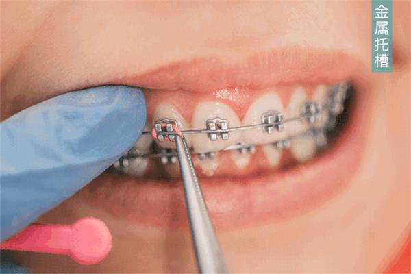 牙冠可以用多久?牙齒鑲嵌過程的視頻
