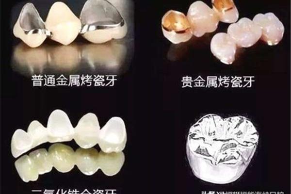 牙冠修復后能用多久