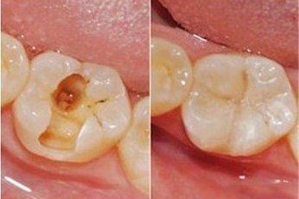 補牙后牙齒維持多久