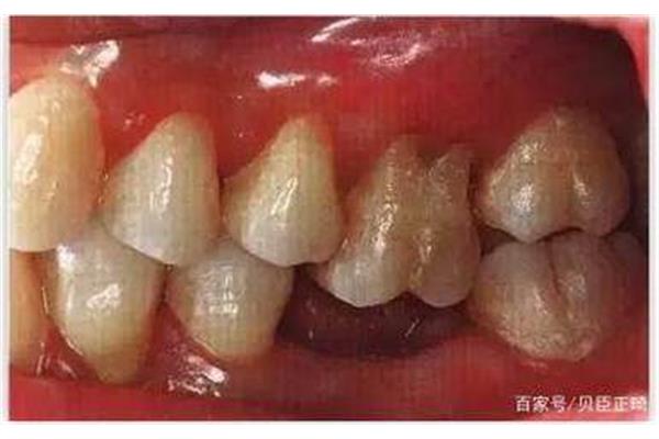 種牙二期手術需要多久