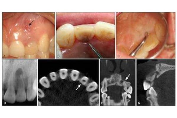 牙齒再植后多久牙齒會變黑,再植后需要多久進行根管治療?