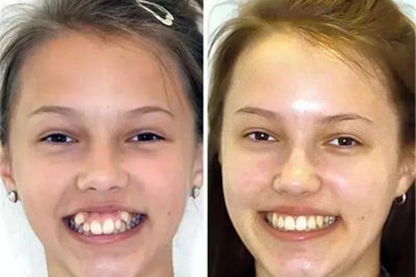 正畸牙齒需要多長時間拔,正畸需要多長時間恢復?