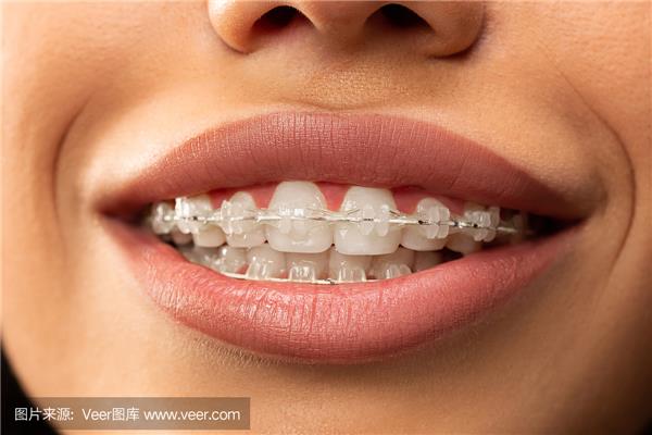每天應該戴多長時間的牙套?隱形牙套每天應該戴多久?
