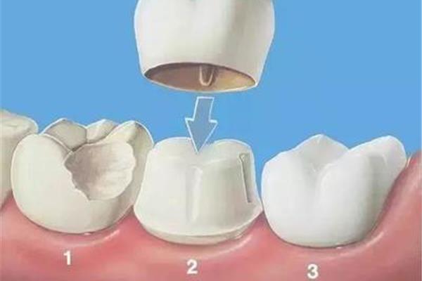 牙齒固位體需要戴多久,應該什么時候戴?