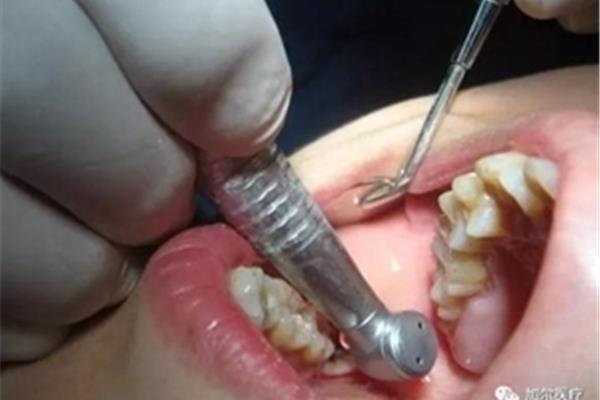 割牙齦拔牙很可怕嗎?智齒恢復需要多長時間?