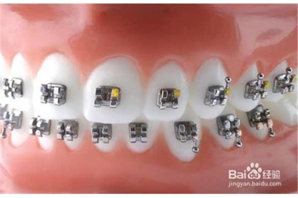 牙套保持器一般要戴多久,牙齒用固位體要多久才能穩定?