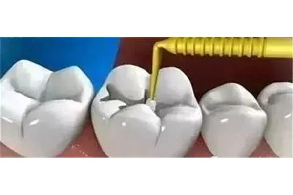 光固化補牙能用多久
