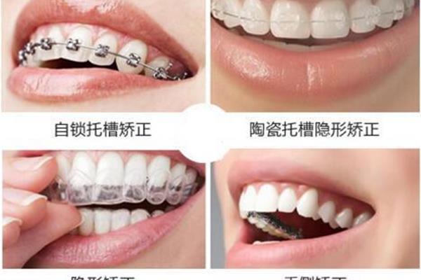 戴牙套牙齒之間的縫隙變大有縫隙可以戴牙套嗎?