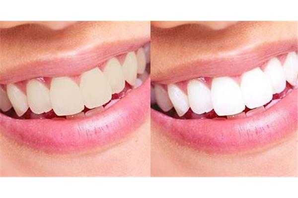 牙齒冷光美白持續多久?牙齒美白步驟