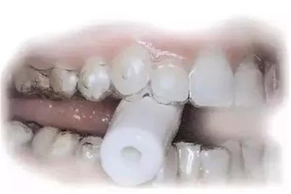 鋼牙牙套多久更換一次,隱形牙套多久更換一次