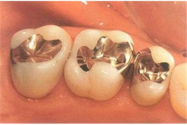 補牙牙套能用多久多久