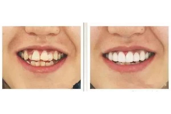 拔正畸牙能戴多久牙套,拔正畸牙能恢復多久?