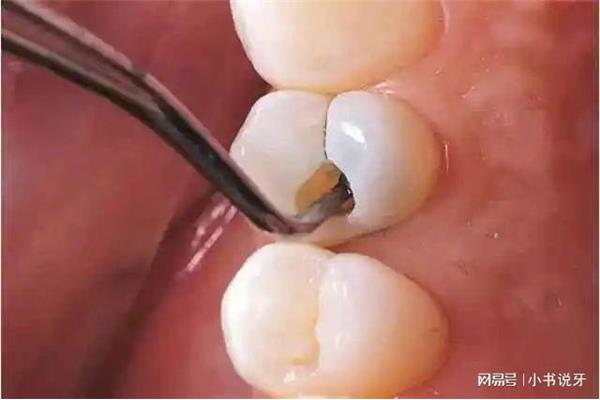 蛀牙多久可以修復,補牙需要多久?