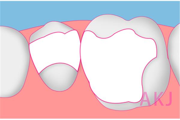 補完牙需要多長時間打磨,補完需要多長時間?