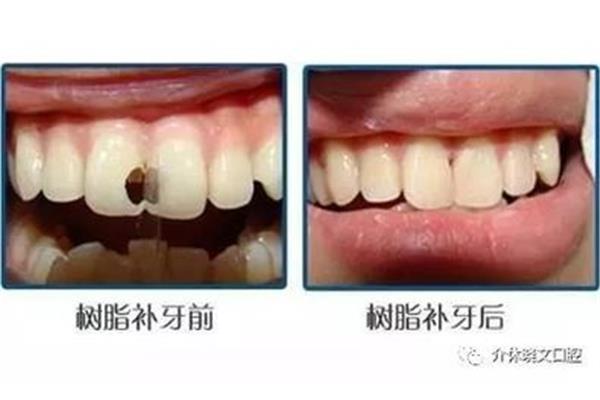 二磨牙拔掉后多久可以補牙?二磨牙補齊需要多長時間?