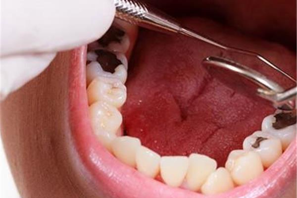 蛀牙神經疼多久,蛀牙會蛀到牙齒神經多久?