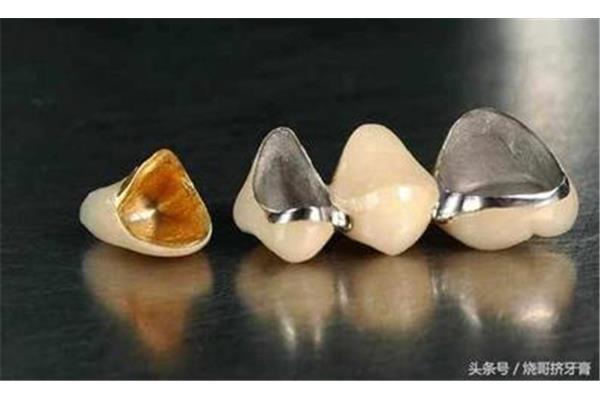 鑲的牙齒能用多久