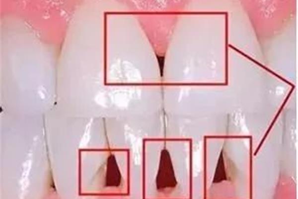 隱形正畸關閉牙間隙和正畸關閉牙間隙需要多長時間?