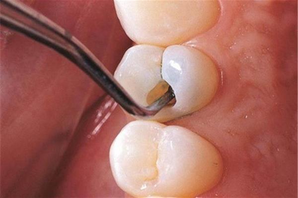 補一個小牙洞要多久,蛀牙是怎么形成的?