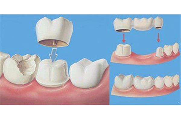 裝一副假牙需要多長時間,需要多長時間適應?