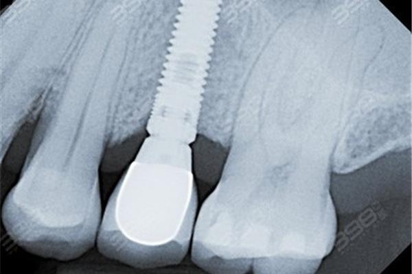 種植牙手術需要多長時間,種植牙手術需要多長時間拆線?