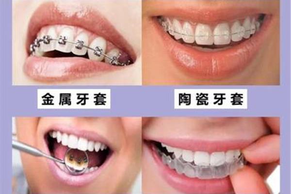 門牙牙套可以維持多久,鈷鉻合金牙套可以維持多久
