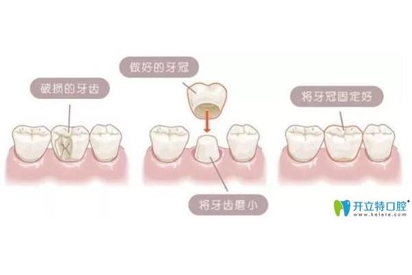 假牙裝多久,成年人矯正牙齒一般需要多久?